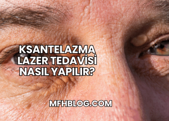 Ksantelazma Lazer Tedavisi Nasıl Yapılır?