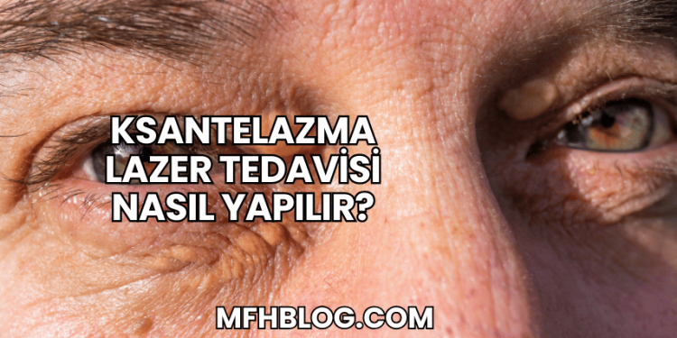 Ksantelazma Lazer Tedavisi Nasıl Yapılır?