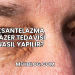 Ksantelazma Lazer Tedavisi Nasıl Yapılır?