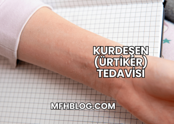Kurdeşen (Ürtiker) Tedavisi
