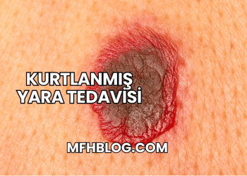 Kurtlanmış Yara Tedavisi