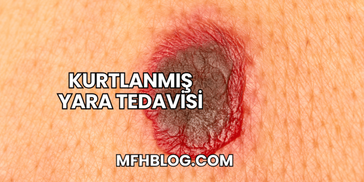 Kurtlanmış Yara Tedavisi