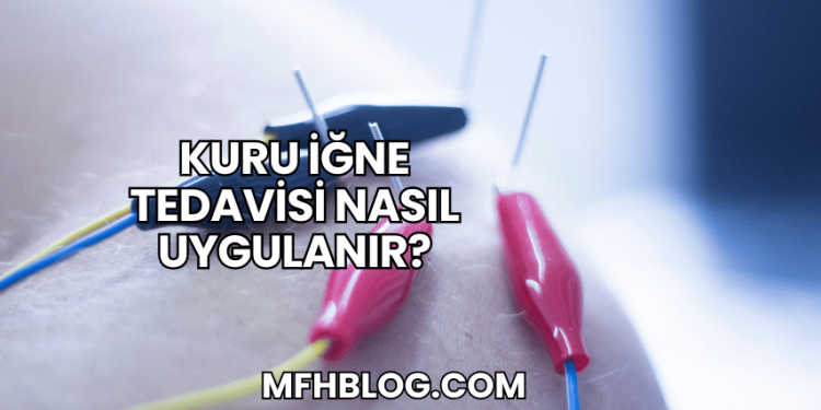 Kuru İğne Tedavisi Nasıl Uygulanır?