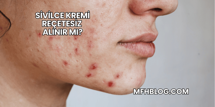 Sivilce Kremi Reçetesiz Alınır mı?