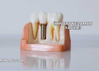 İmplant Ne Zaman Yapılır?
