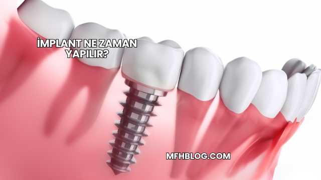 İmplant Ne Zaman Yapılır?