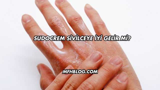 Sudocrem Sivilceye İyi Gelir mi?