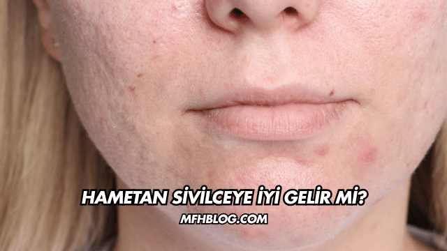 Hametan Sivilceye İyi Gelir mi?