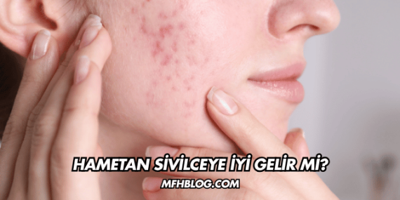 Hametan Sivilceye İyi Gelir mi?