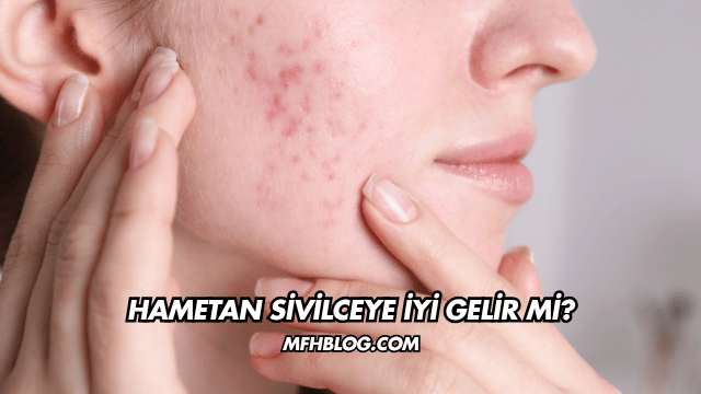Hametan Sivilceye İyi Gelir mi?